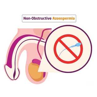 Azoospermia Treatment without any Surgery in Thiruvarur & Mayiladuthurai, Tamil Nadu male infertility care