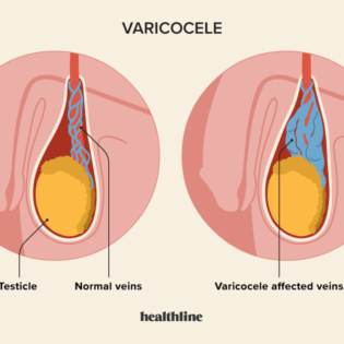 Homeopathic solutions for infertility in Thiruvarur, Treatment for sperm issues, Varicocele Treatment without Surgery
